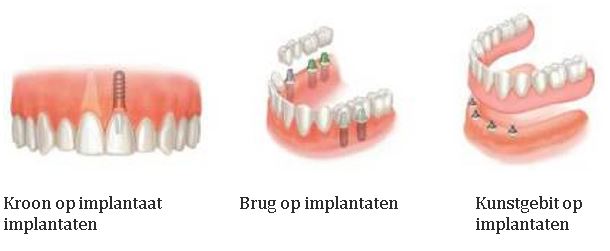 Implantaten